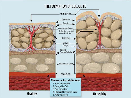 Celulitis como se forma