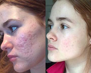 crema para el acné antes y después